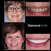 Resultaat van Diamond Smile Tanden Bleken Power+ Telefoon Bleek Mondstuk - Mond met voor en na foto van witte tanden