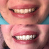 Resultaat met de Power LED bleaching sonische tandenborstel van Diamond Smile met voor en na foto van het bleken van tanden