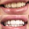 Ervaring met de Power LED bleaching sonische tandenborstel van Diamond Smile met voor en na foto van het bleken van tanden