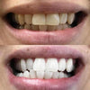 Resultaat van Diamond Smile Tanden Bleken Power+ Telefoon Bleek Mondstuk - Mond met voor en na foto van witte tanden