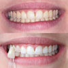 Diamond Smile Tandbleek Power+ Telefoonbleek Mondstuk - Mond met voor en na foto van witte tanden